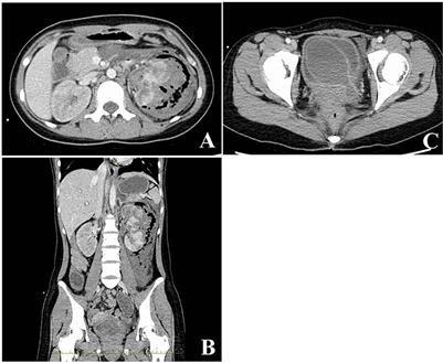 Case Report: Emphysematous Pyelonephritis With a Congenital Giant Ureterocele